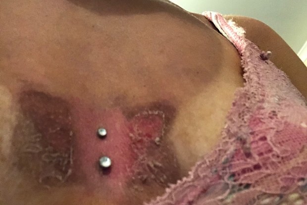 Bandaids and similar products cause horrific burns.