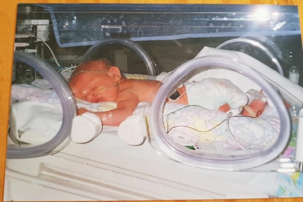 She had her first surgery at 15-months.