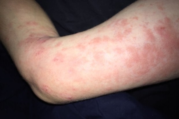 Ryder suffers from a chronic skin condition