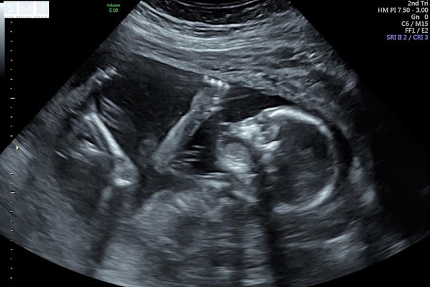 Lauren and Trent are expecting their first child in November.