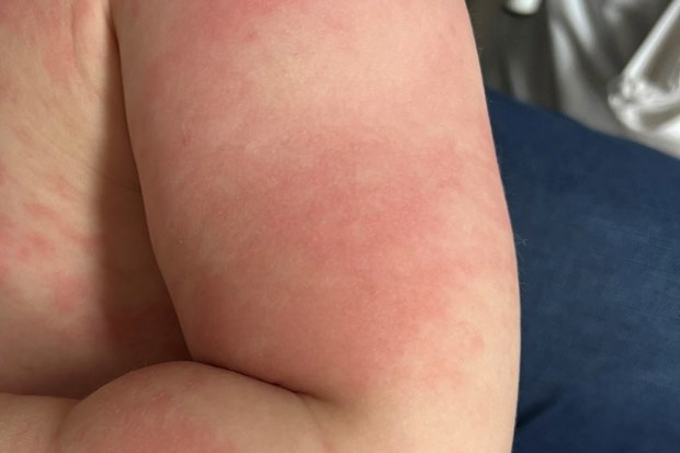 Allegra's rash turned up after days of fevers.