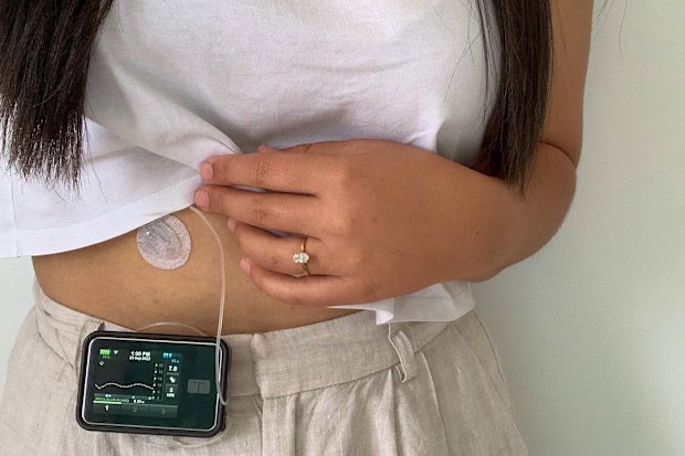 Emily Vilé shows the insulin pump on her stomach.