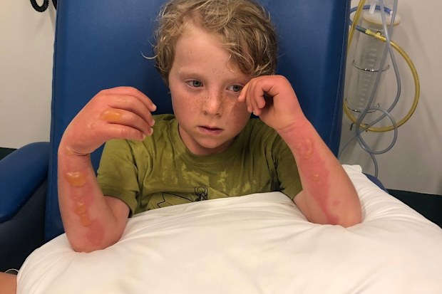 NSW mum Catherine Kerr's son suffered 'margarita burns' after juicing limes and playing in the sunshine.