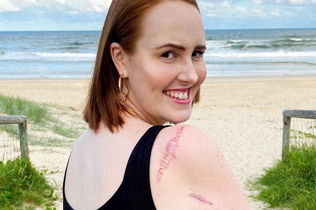 Skin cancer survivor Courtney Mangan shows the scars on her arm.