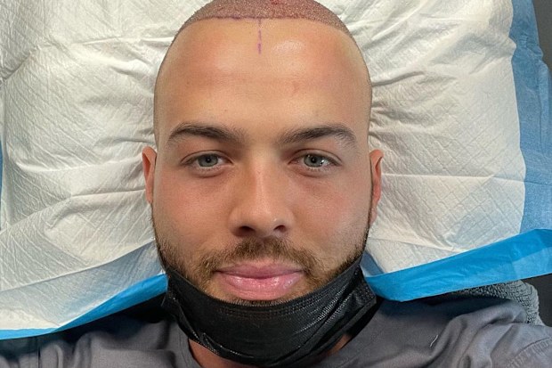 MAFS, Samuel Levi, hair transplant procedure