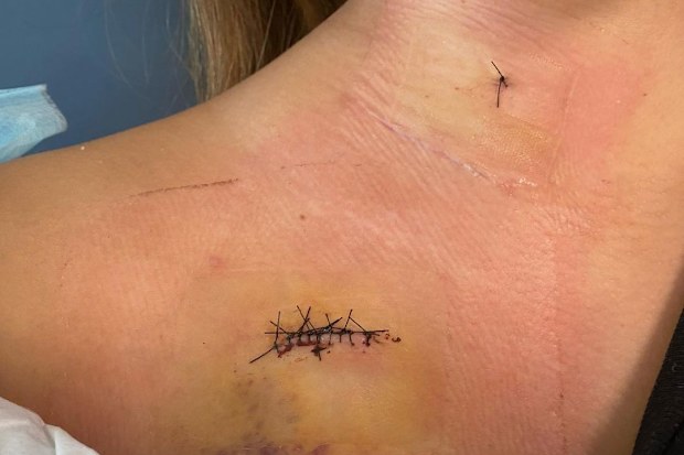 The lumps were cut out of Maddie King's neck three months after she found them.