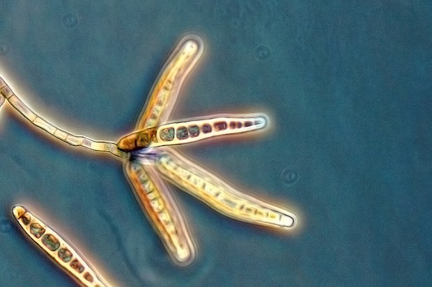 Fungal Meningitis