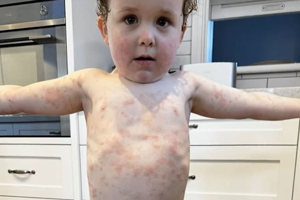 Breakthrough eczema research
