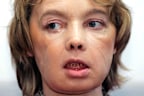 <p>Isabelle Dinoire received the world's first partial face transplant on November 27, 2005, in a complex and daring operation that set the stage for dozens of similar transplants worldwide.</p><p>After being severely disfigured by her pet labrador, the French woman was given a new nose, chin and lips in a ground-breaking, 15-hour operation iin the Amiens hospital. </p><p>When she first appeared in public with her new face four months later, her speech was slurred and a scar clearly visible — but the fact that she could speak to reporters of having a "face like everyone else" and almost smile was seen as a medical breakthrough.</p>