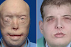 <p>Volunteer US firefighter Patrick Hardison underwent the world's most extensive face transplant surgery in New York on August 14, 2015.</p><p>Fourteen years earlier, when Hardison entered a burning home on a rescue search, the roof collapsed on him and his firefighter's mask burned onto his face. ﻿</p><p>He was left with disfiguring burns across his entire face, head, neck, and upper torso. He lost his eyelids, ears, lips, and most of his nose, as well as his hair, including his eyebrows.</p>