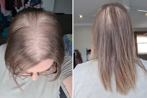 Nikita Liang's hair was so thin you could see her scalp through it.