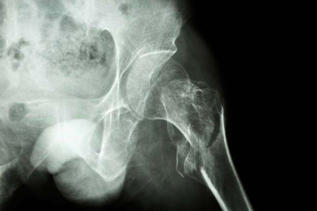 film x-ray show intertrochanteric fracture left femur