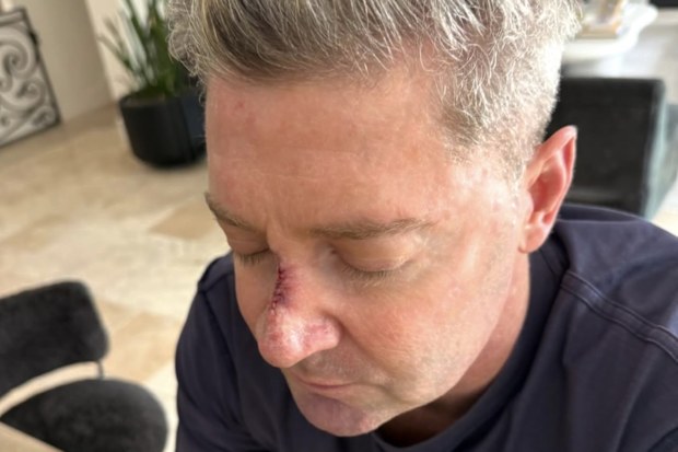 Michael Clarke skin cancer