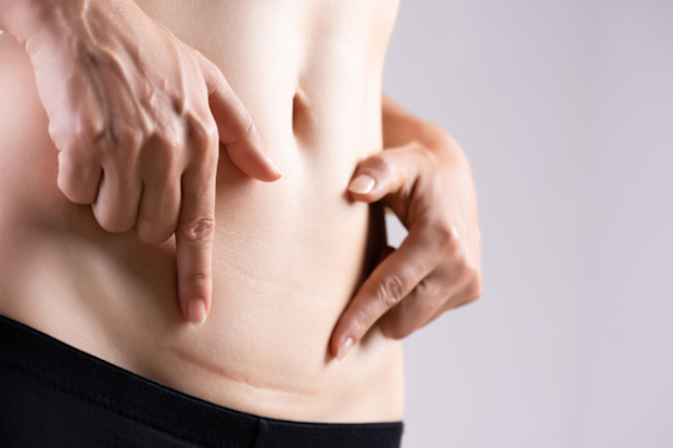 Woman with a c-section scar