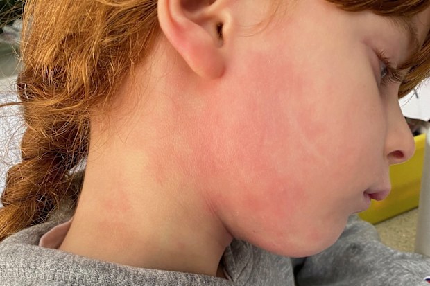 Amelia relies on multiple daily applications of creams to help manage her eczema.