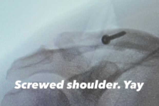 Channing Tatum shares X-ray images before and after shoulder surgery