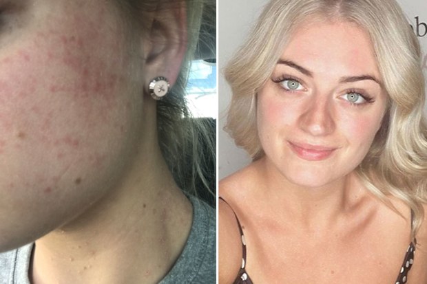 I have been so ashamed of my psoriasis I have avoided people, sold festival tickets, and cancelled dates. 