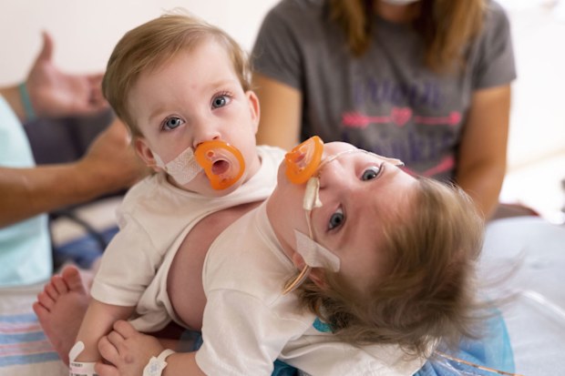 Michigan conjoined twins separated