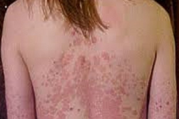 Woman with chronic psoriasis on her torso