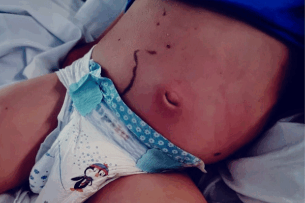 Tommy's stomach became red and swollen after taking  a dose of ibuprofen.