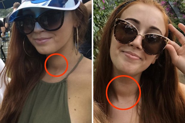 The lump in Kodi Brown's throat was visible in photos.