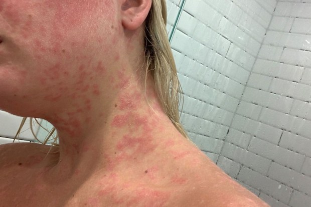 Ash Kent psoriasis
