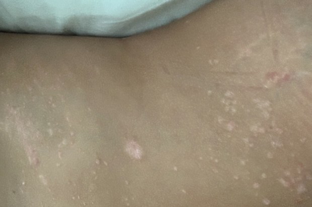 January 2019, Ashley's psoriasis got bad all over her torso.