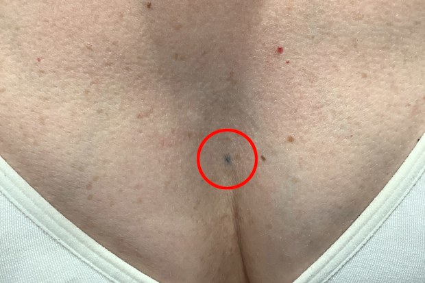 Lisa Mansfield's radiation tattoo before laser treatment.