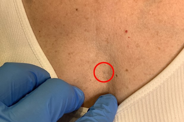 Lisa Mansfield's radiation tattoo after laser treatment.