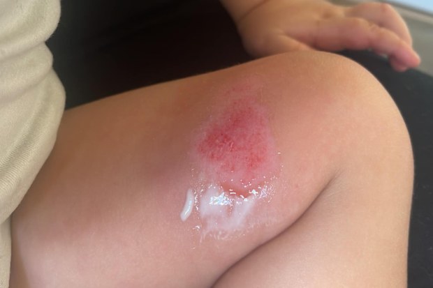 Burn on toddler's leg.