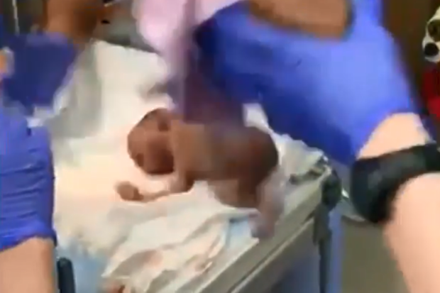 Baby girl accidentally dropped on her head by doctors