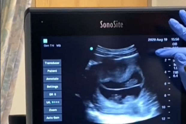 superfetation pregnancy