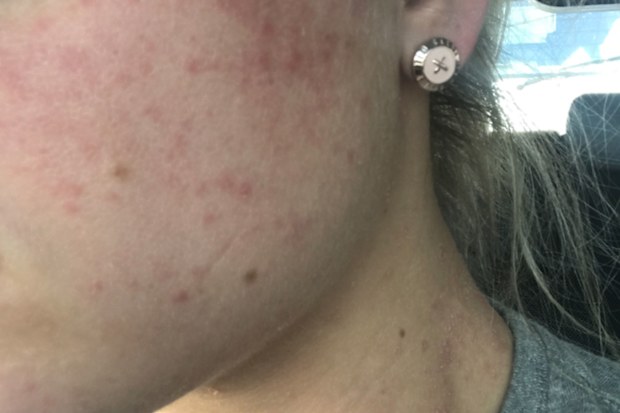 Ashley had psoriasis from the top of her head, down her face and neck in 2016.