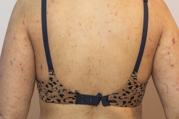 Jessica Peters eczema