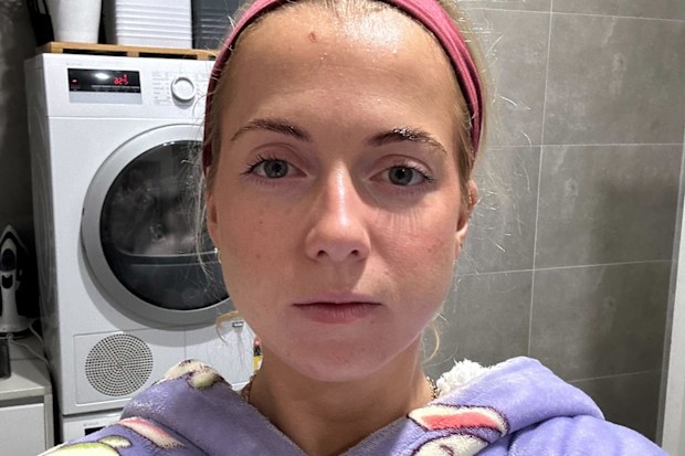 The pink spot on Rachael's head turned out to be skin cancer.
