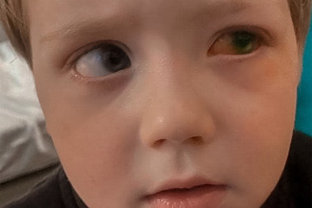 Boy with eye injury.