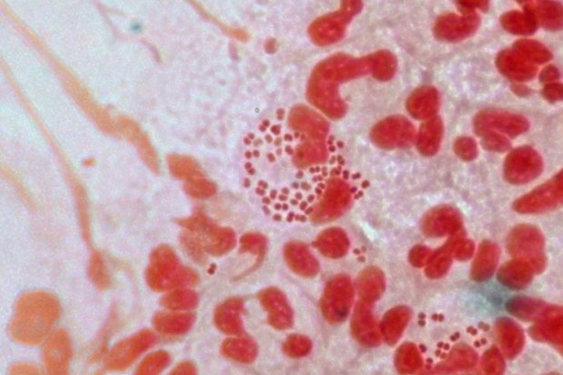 A strain of 'superbug' gonorrhoea has been reported in several countries including Australia, the United Kingdom, France, Japan and Spain.
