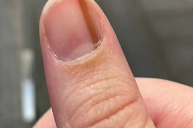 Cancer on thumb discover
