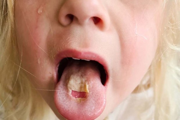 Little girl showing her burnt tongue