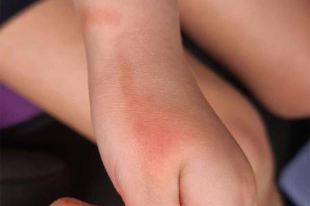 Tracking line on child's hand after mosquito bite.