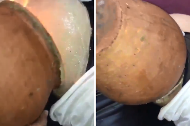 'Fire cupping' bum lift