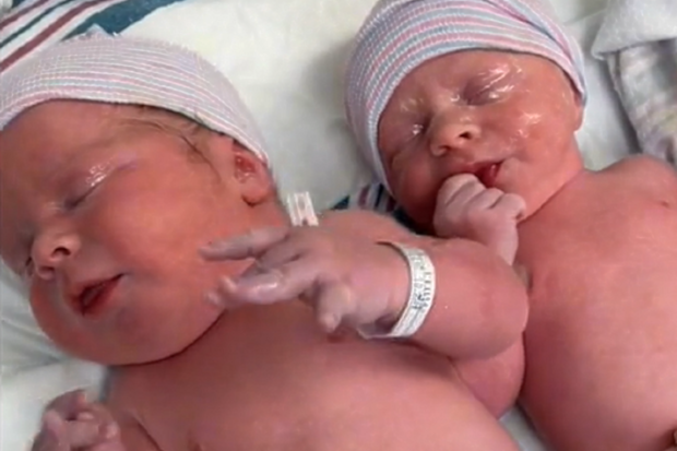 twins born with key size difference TikTok