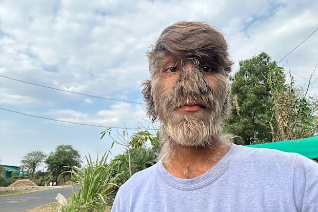 Lalit Patidar, 18, has the rare condition hypertrichosis, which has helped him set a Guinness World Record.