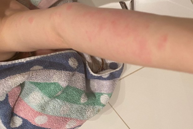 As well as living with the skin condition, Amelia also developed allergies to dust, animal dander and grasses.