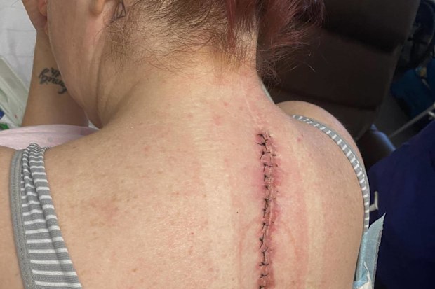 Allison Willcox shows just one of the scars on her back from surgery.