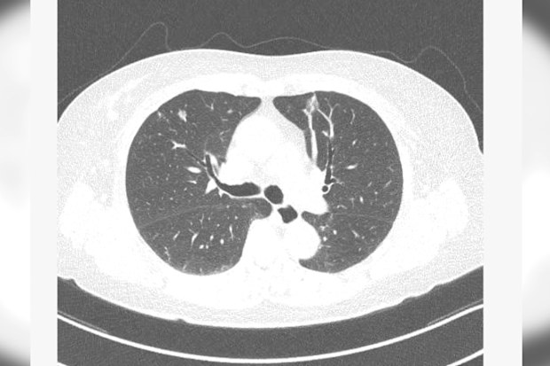 New treatment for lung cancer