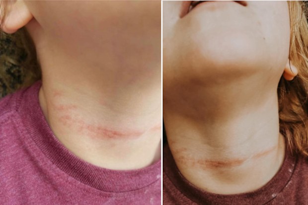 A mother posts photos online of the deep lines left by blind cords.