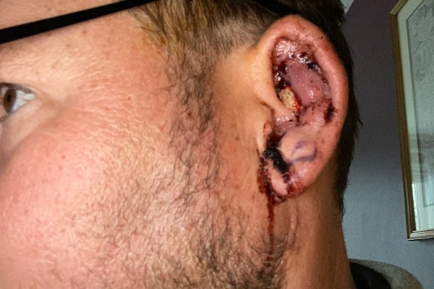 Alexander Gupman had surgery on his ear.