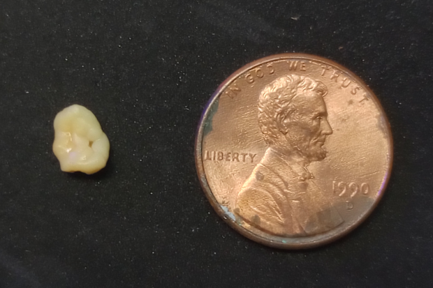 Tonsil stone reddit