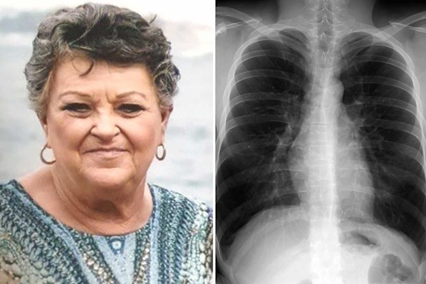 Linda Goldsmith (left) was living with COPD for years before she was diagnosed. An X-ray showing a patient with COPD (right).